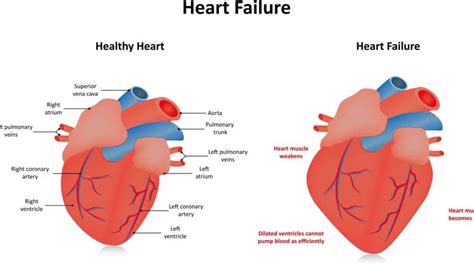 global hypokinesis of lv|global hypokinesis causes.